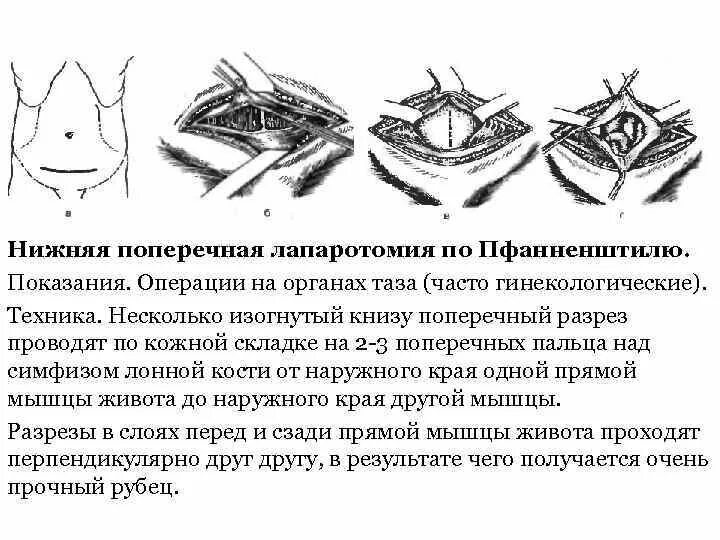 Техника кесарева. Разрез по Пфанненштилю операция. Пфаненштиль лапаротомия. Техника кесарева сечения с лапаротомией по Пфанненштилю.