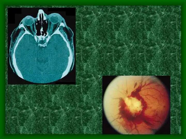 Патология зрительного нерва. Врожденная аномалия диска зрительного нерва. Внутричерепная патология сосудистая. Врожденные нарушения зрительного нерва.