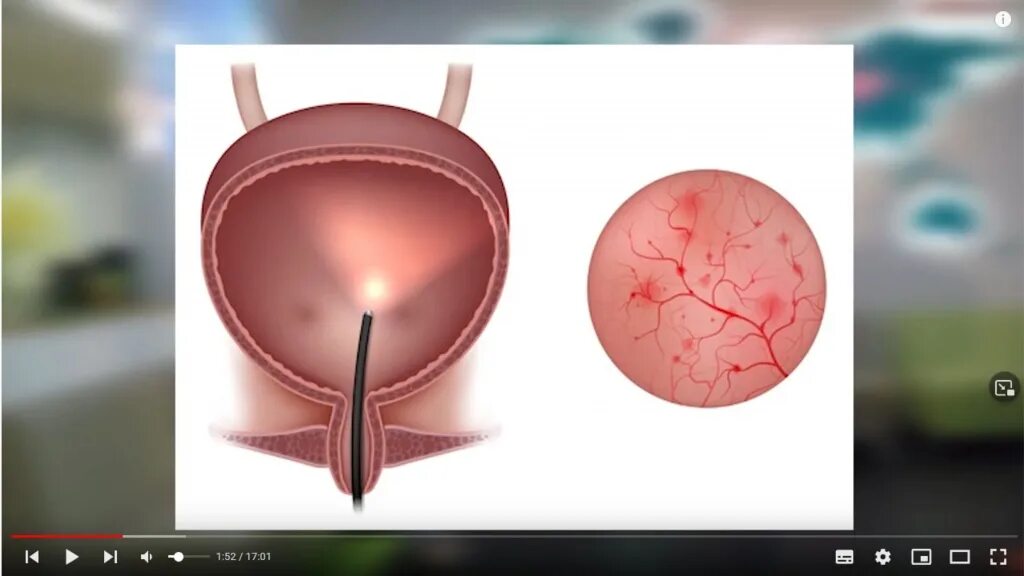 После лучевой цистит. Гипертрофический цистит.