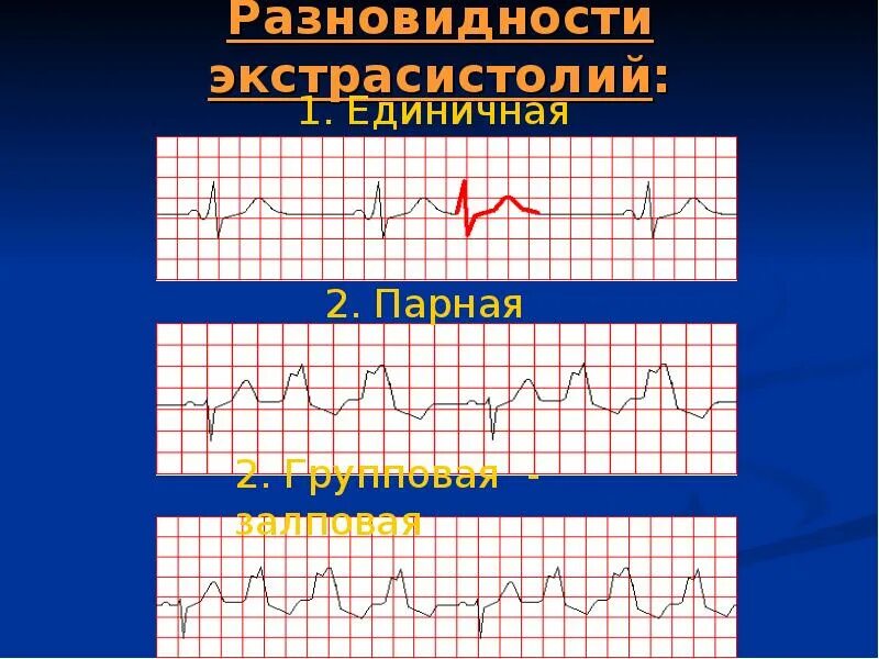 Единичная парная. Политопная предсердная экстрасистолия. Парные политопные желудочковые экстрасистолы. Единичные экстрасистолы. Парная экстрасистолия.