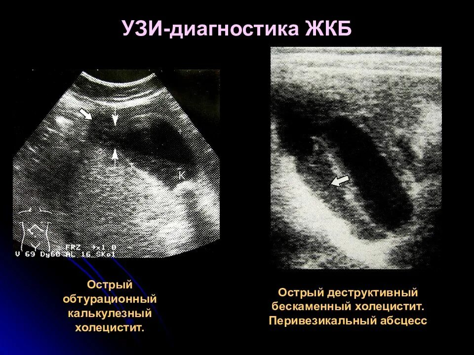 Сморщенный желчный пузырь. ЖКБ острый калькулезный холецистит УЗИ. Калькулезный холецистит на УЗИ. УЗИ желчного пузыря холецистит.