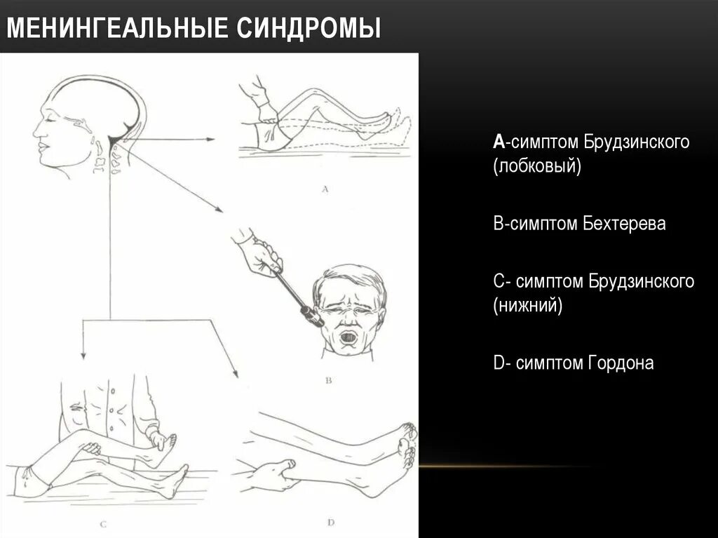 Симптомы Кернига, Брудзинского, скуловой симптом Бехтерева. Симптом Бехтерева менингит. Симптом Бехтерева менингеальный. Менингеальные синдромы Брудзинского.