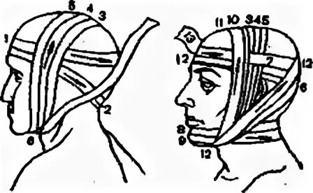 Техника наложения мягких повязок. Бинтовая повязка уздечка. Круговая бинтовая теменно-подбородочная повязка. Повязка уздечка техника наложения.