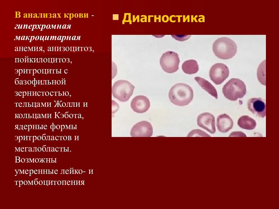 Пойкилоцитоз анемия. Анизоцитоз и пойкилоцитоз при анемии. Эритроциты с тельцами Жолли и базофильной зернистостью. Базофильная зернистость эритроцитов; тельца Гейнца. Базофильная зернистость ретикулоцитов.