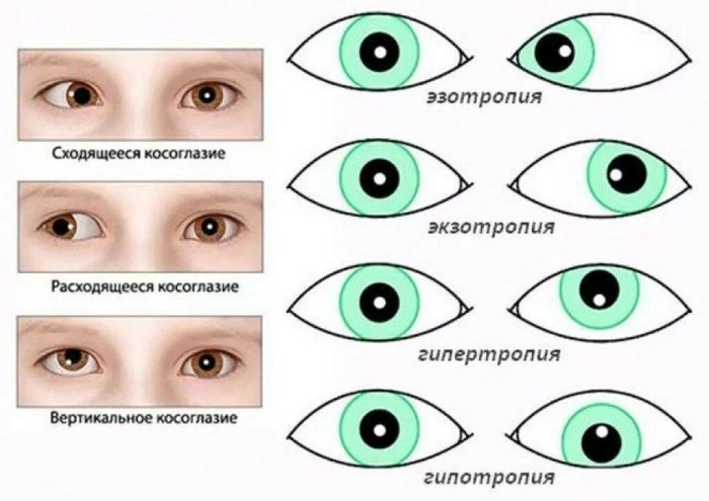 Сходящееся косоглазие. Косоглазие схема. Косоглазие у детей. Сходящееся и расходящееся косоглазие (страбизм). Какой глаз левый а какой правый