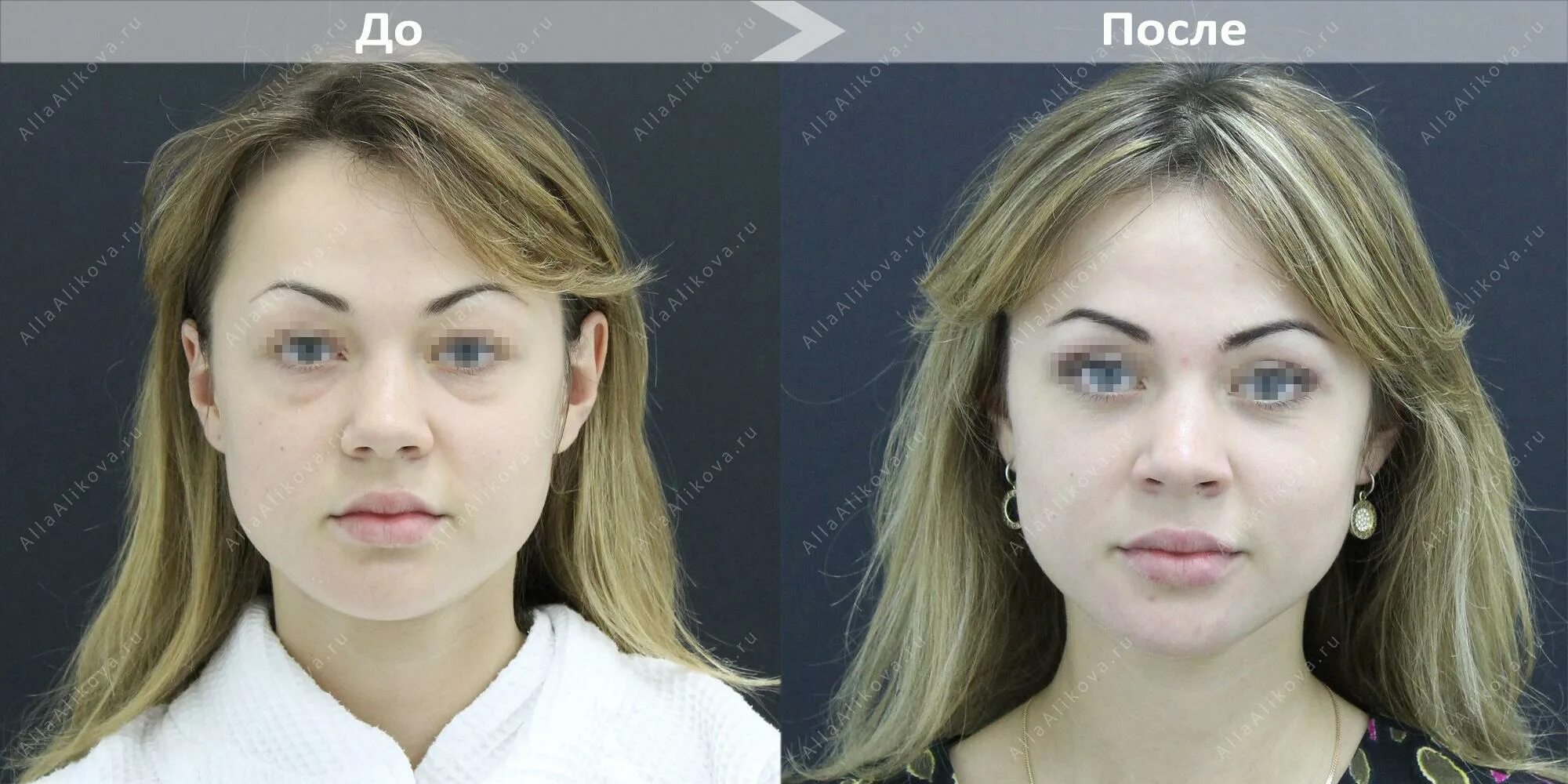 Косоглазие до и после операции