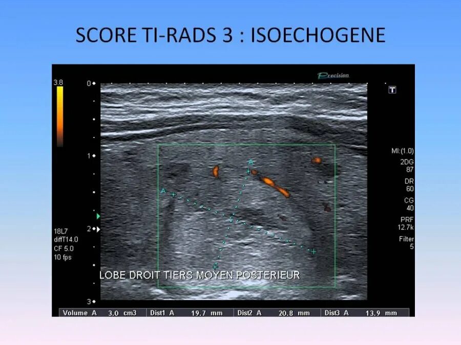 Eu tirads. Тирадс 3. Тирадс УЗИ. УЗИ примеры тирадс. Шкала тирадс для УЗИ щитовидной железы.