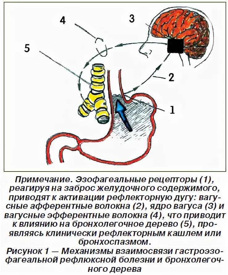 Кашель при рефлюксе у взрослых. Кашель при гастроэзофагеальной рефлюксной. Патогенез кашля при ГЭРБ. Кашель при ГЭРБ. Рефлекторный кашель симптомы.