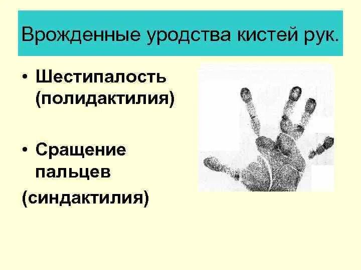 Постаксиальная полидактилия кистей. Полидактилия шестипалость. Врожденное уродство кистей рук.