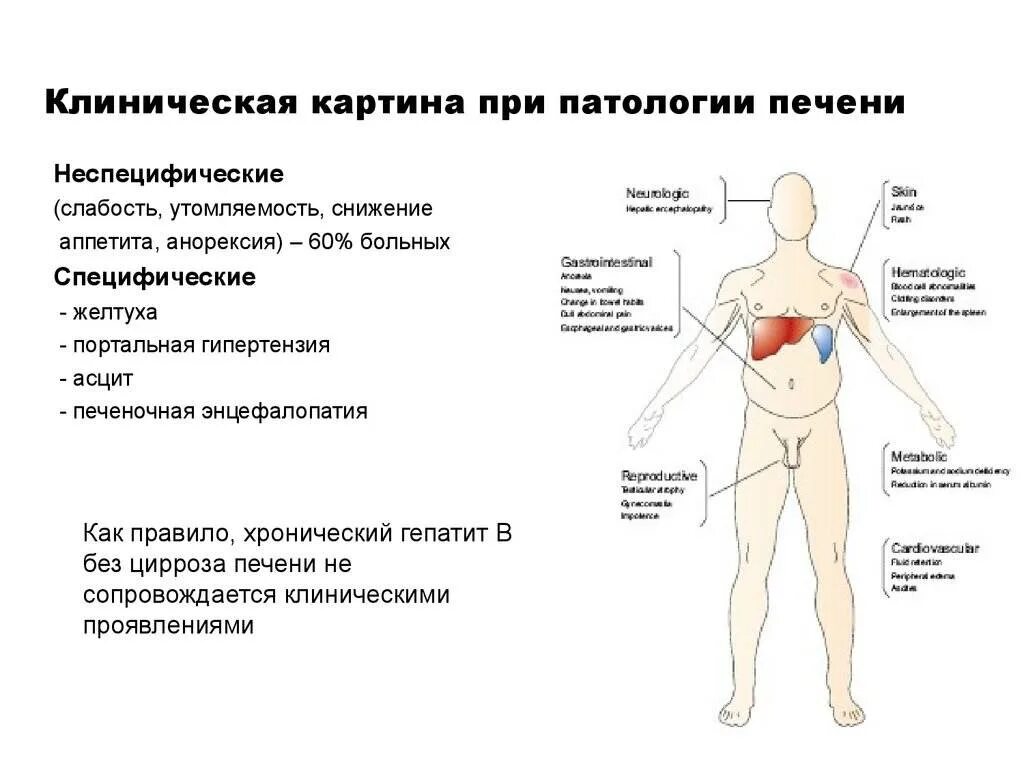 Боли при больной печени. Клинические симптомы цирроза печени. Как понять что болит печень. Синдромы в клинической картине циррозов печени. Проблемы с печенью симптомы у женщин.