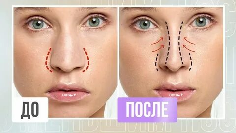 Как уменьшить нос без