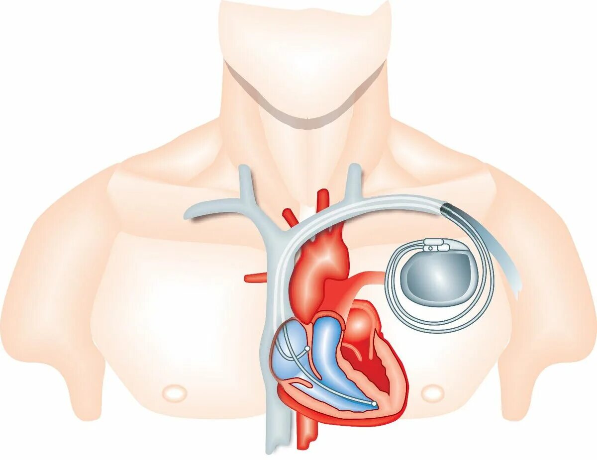 Если стоит кардиостимулятор можно. Кардиостимулятор Pacemaker. Операция кардиостимулятор сердца. Имплантация сердца кардиостимулятор. Электрокардиостимулятор имплантируемый однокамерный.