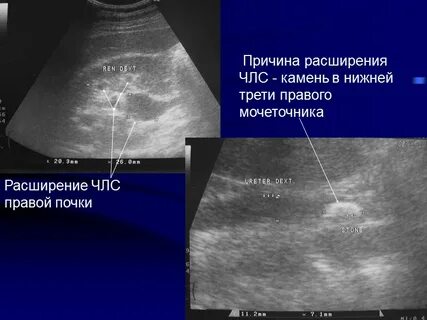 Расширение справа