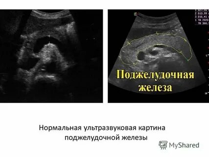Узи печени желчного пузыря поджелудочной