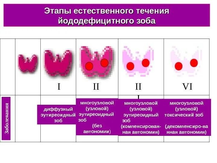 Эутиреоидный многоузловой зоб щитовидной железы 2 степени. Этапы формирования узлового зоба. Нетоксичный эутиреоидный зоб 1 степени. Узловой зоб щитовидной железы 1 см.