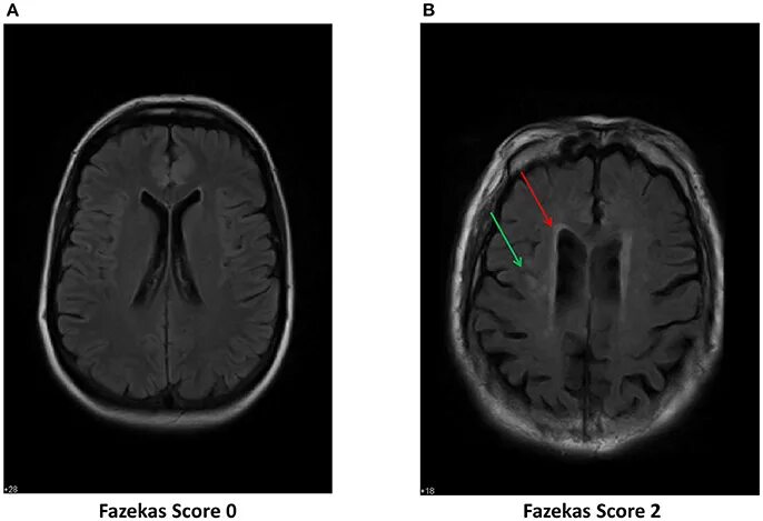 Микроангиопатия головного мозга fazekas. Лейкоареоз по Фазекас. Лейкоареоз Fazekas 1. Лейкоареоз Fazekas 2. Фазекас 3.