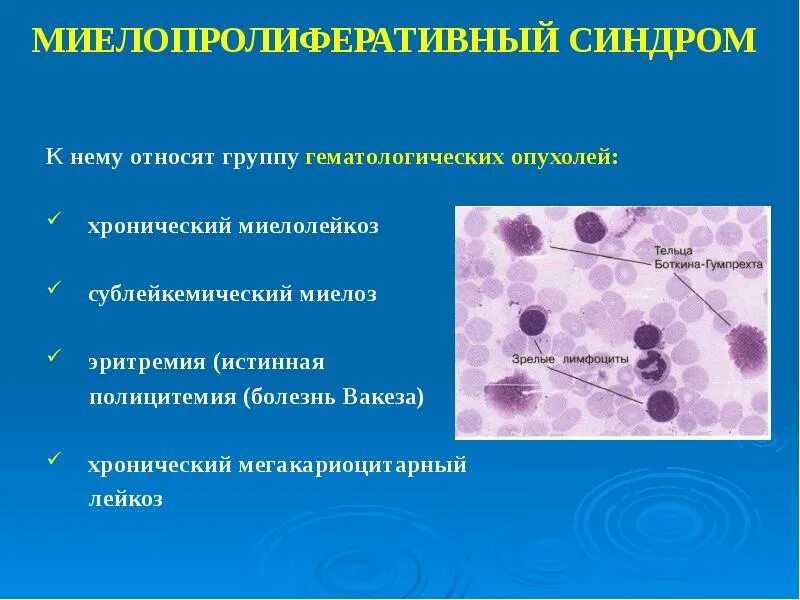 Хронический миелопролиферативный лейкоз. Заболевание крови миелолейкоз. Хронические миелопролиферативные заболевания крови. Хронический мегакариобластный лейкоз.