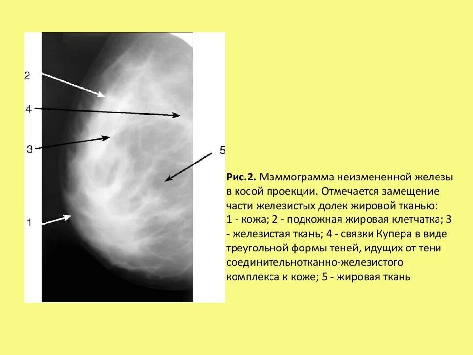 Фиброзно жировая ткань при маммографии. Маммография снимки фиброзно-жировая инволюция. Жировая инволюция молочных желез маммография. Железистая и жировая ткань молочных желез на УЗИ.