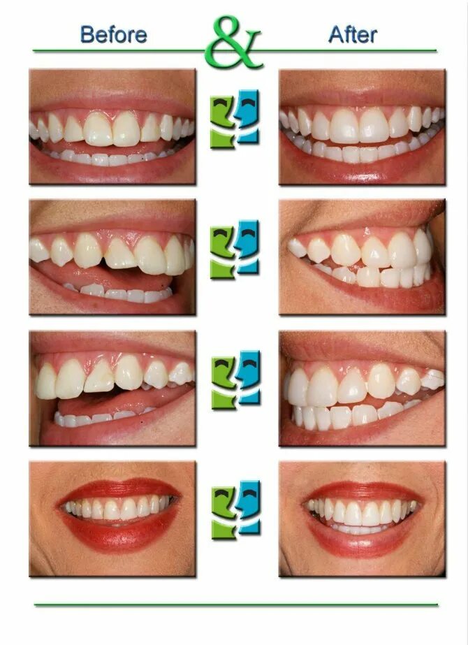 Что делают клыки зубы. Наращивание зубов острые зубы. Клыки стоматологические.