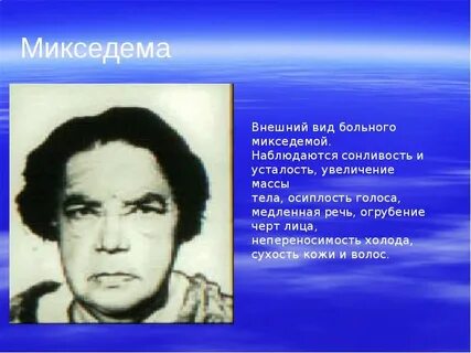Микседема при гипотиреозе