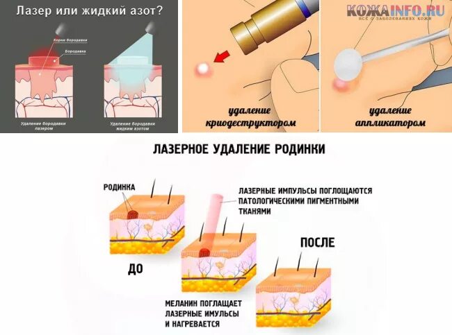 Заживление удаленной родинки лазером. Родинка после удаления лазером. Хирургическое иссечение родинки. Лазерный отзывы пациентов