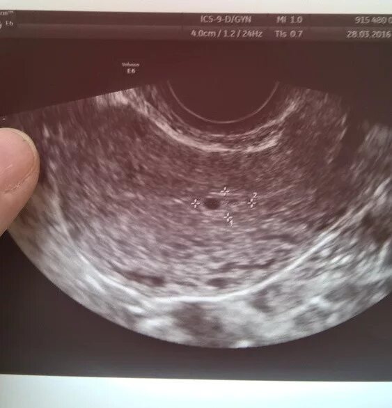 Эмбрион на 2 неделе беременности. УЗИ на 2-4 недели беременности. УЗИ 3-4 недели беременности. УЗИ 2-3 недели беременности. УЗИ беременности на 3 недели беременности.