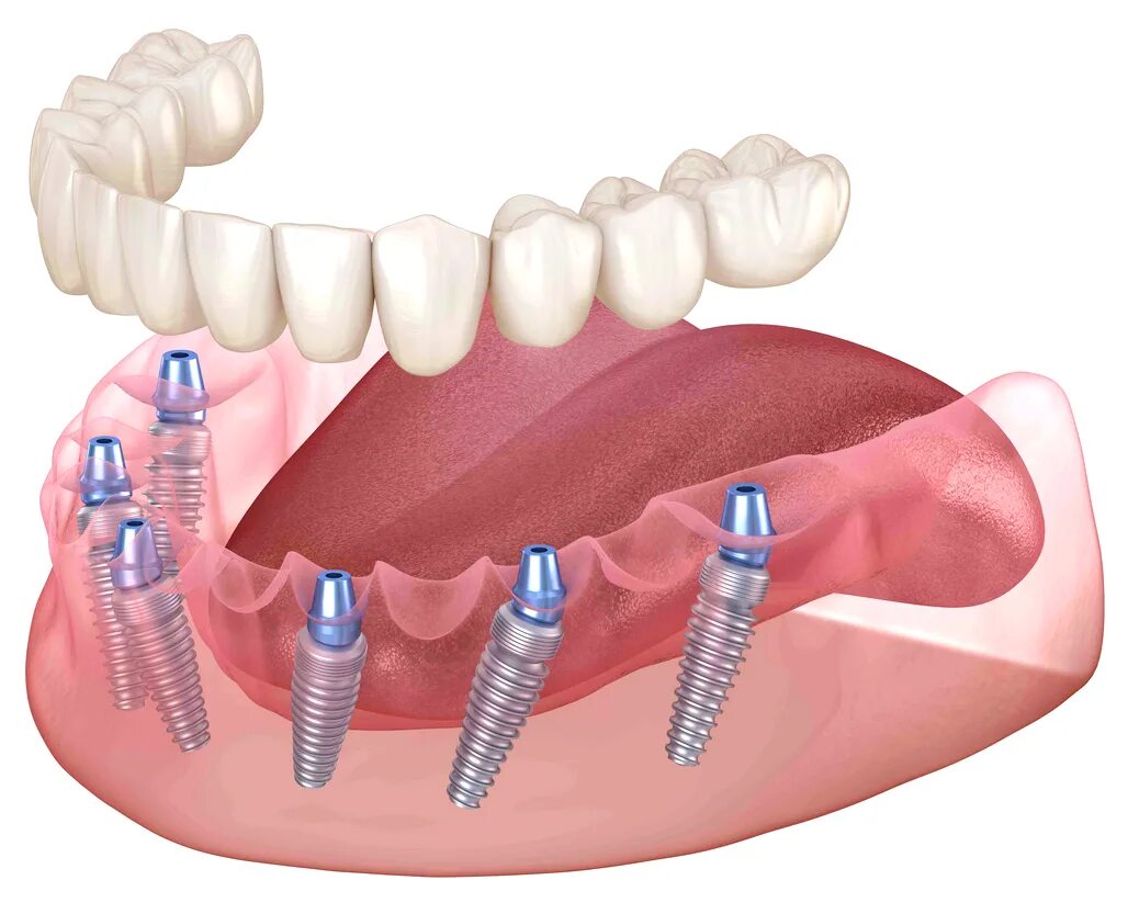 Имплантация "all on 6" Nobel Biocare (США-Швеция). Имплантация челюсти на 6 имплантах. Имплантация зубов all on 6. All-on-6 6 имплантов протез.