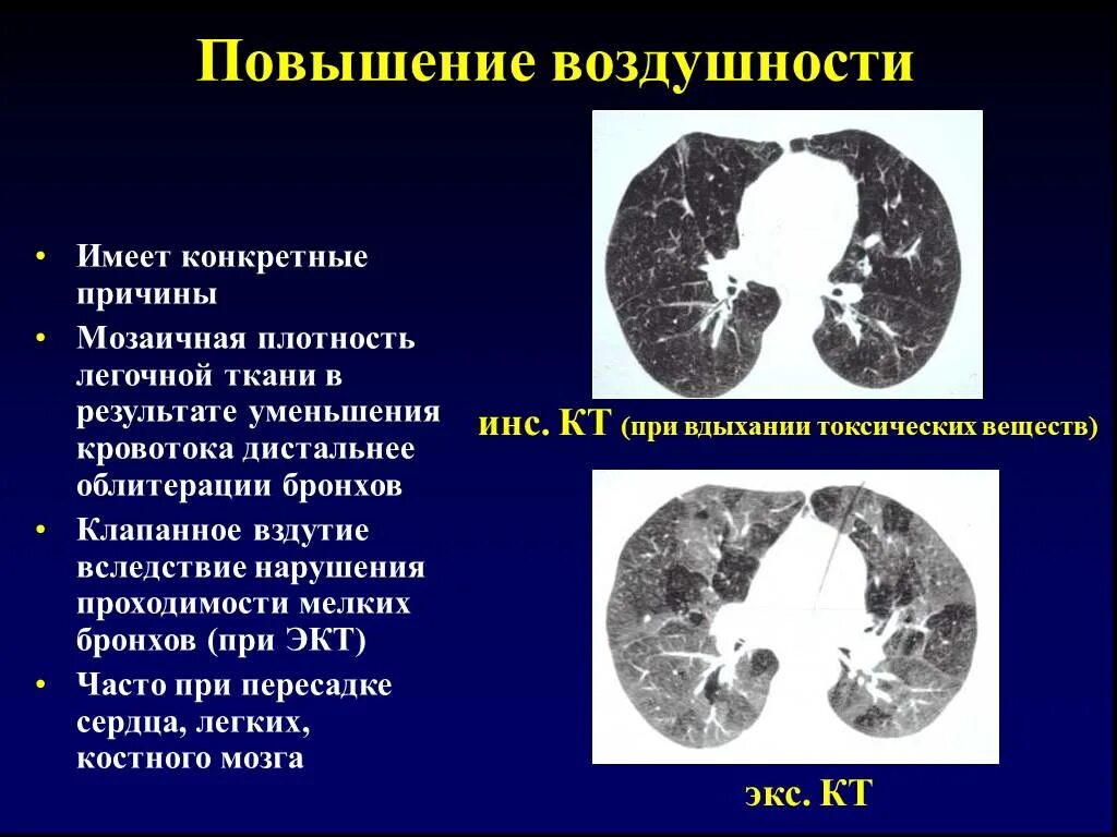 Плотность легкого материала. Повышение воздушности легочной ткани на кт. Снижение пневматизации легочной ткани на кт. Мозаичная структура легочной ткани. Плотность легочной ткани.