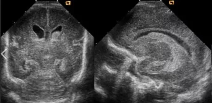 У плода киста мозга сплетения. НСГ УЗИ головного мозга. УЗИ головного мозга нейросонография. Субэпендимальная киста нейросонография.
