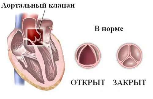 Уплотнение клапанов сердца что это
