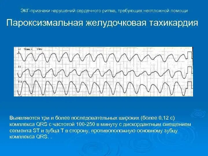 Желудочковая тахикардия на экг