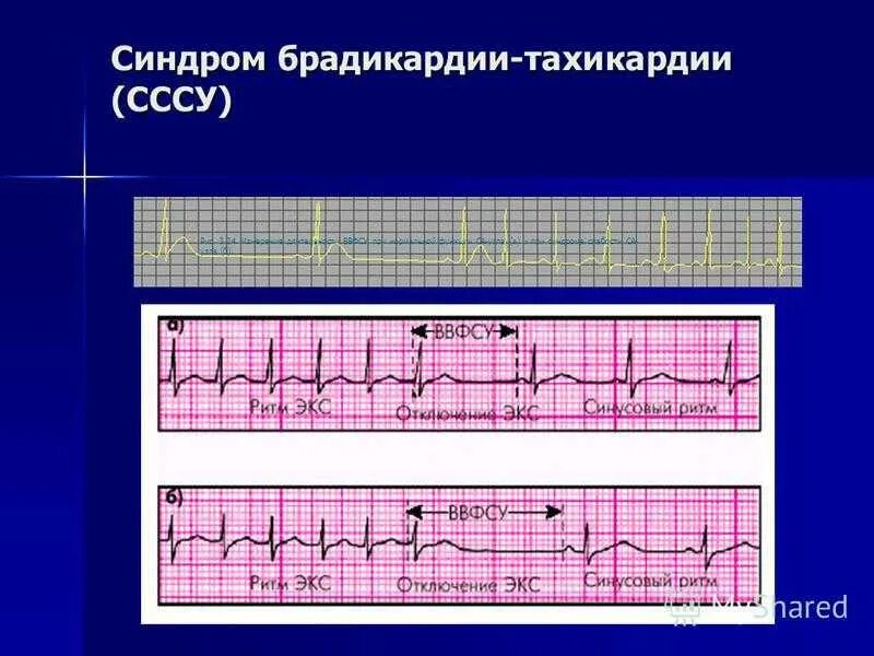 Синдром тахикардии-брадикардии на ЭКГ. Синусовая бради тахикардия. Брадикардия на ЭКГ. СССУ синусовая брадикардия.