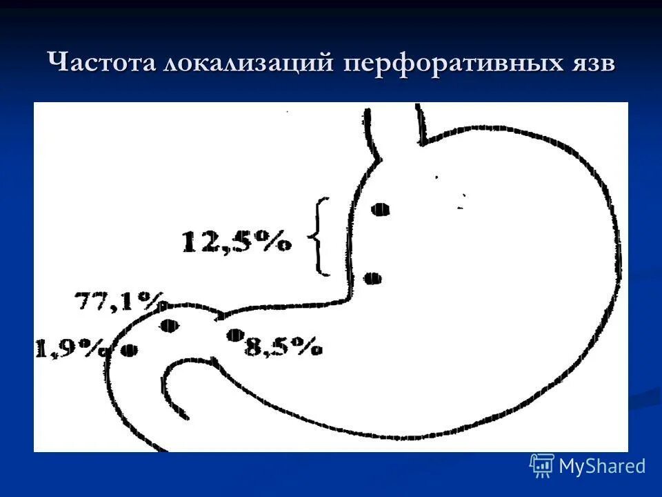 Язвенная болезнь по локализации. Язва желудка и 12 перстной кишки. Антральный и пилорический отделы желудка. Язвенная болезнь антрального отдела желудка. Наиболее частая локализация язвы желудка.