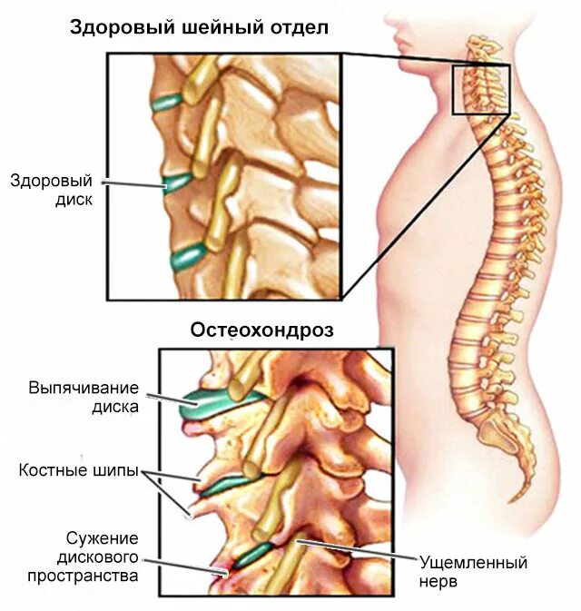 Хандрос сильная боль. Остеохондроз th5-th8. Остеохондроз шейного отдела позвоночника. Остеохондроз шейного отдела с3-с4 с4-с5. Остеохондроз 4-7 позвонков.