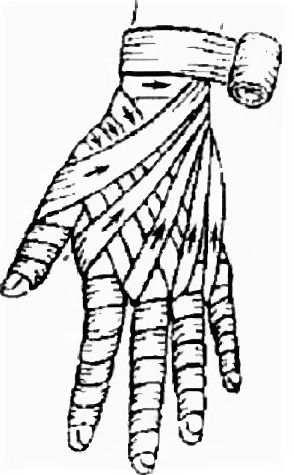 Техника наложения повязки перчатка. Рыцарская перчатка десмургия. Рыцарская перчатка перевязка. Перевязка Рыцарская перчатка алгоритм. Наложить повязку Рыцарская перчатка.