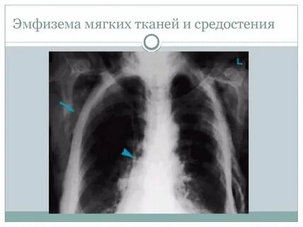 Повреждения средостения