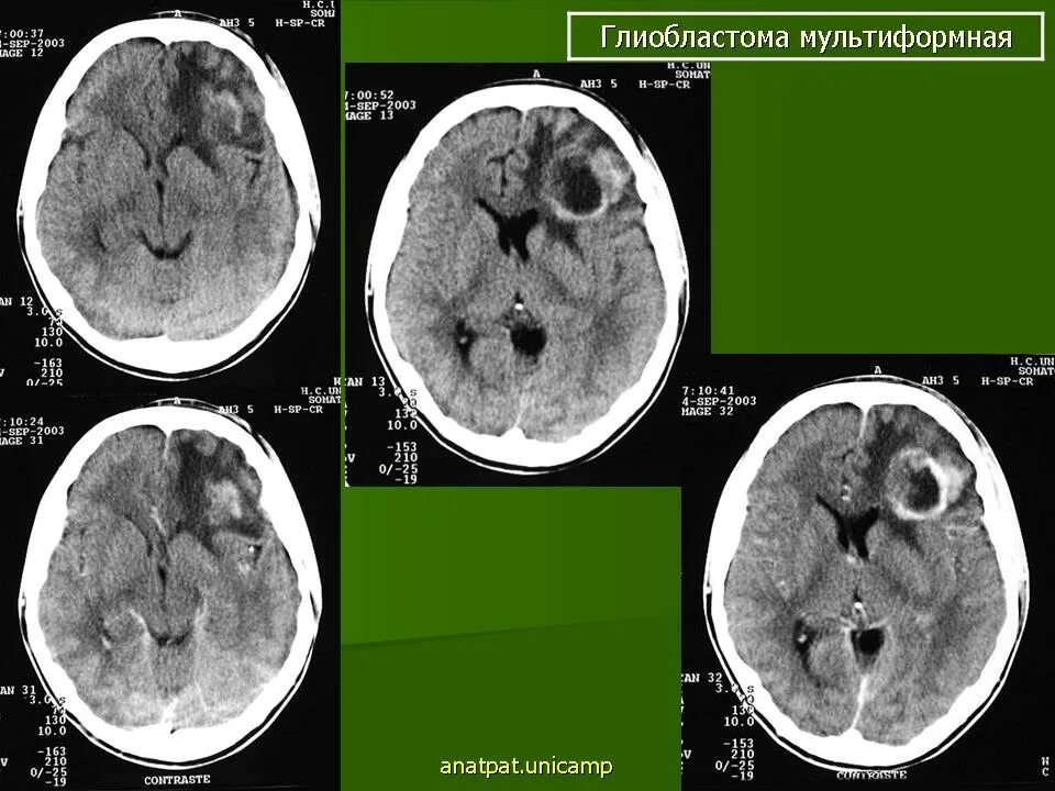 Глиобластома мозга симптомы. Глиобластома головного мозга мрт. Глиобластома мультиформная степень 4. Мультиформная глиобластома мрт. Глиобластома головного мозга на кт.