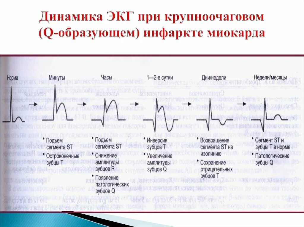 Изменение зубца q. ЭКГ признаки крупноочагового инфаркта миокарда. ЭКГ признаки острейшей стадии инфаркта миокарда. ЭКГ при инфаркте миокарда с патологическим q. Острый трансмуральный инфаркт миокарда ЭКГ.