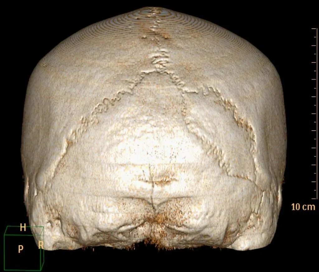 Шов теменных костей. Ламбдовидный шов теменной кости. Ламбдовидный шов черепа. Сагиттальный шов черепа. Лямбдовидный шов черепа.