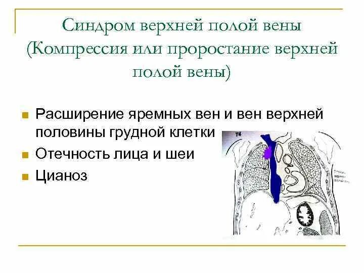 Синдром пола. Сдавление верхняя полая вена. симптомы сдавления верхней полой вены. синдром сдавления верхней полой вены клинические рекомендации. синдром сдавления верхней полой вены клиника.