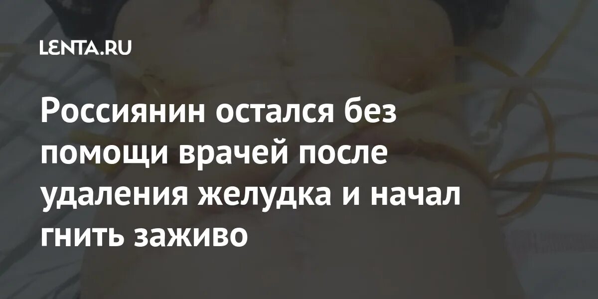 Умер от резекции желудка. Гнила заживо в больнице. Гниющие заживо люди фото.