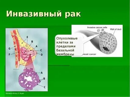 Инвазивная карцинома неспецифического типа что значит