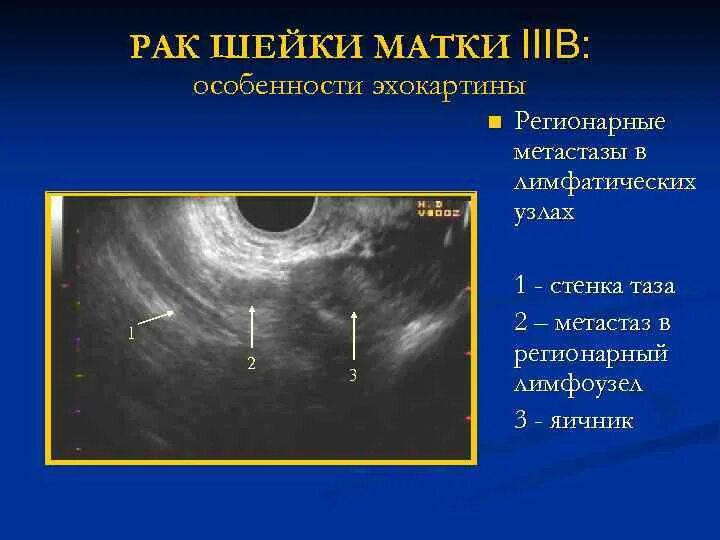 Новообразования шейки матки. Опухоль шейки матки на УЗИ. Рак шейки матки на узи виден