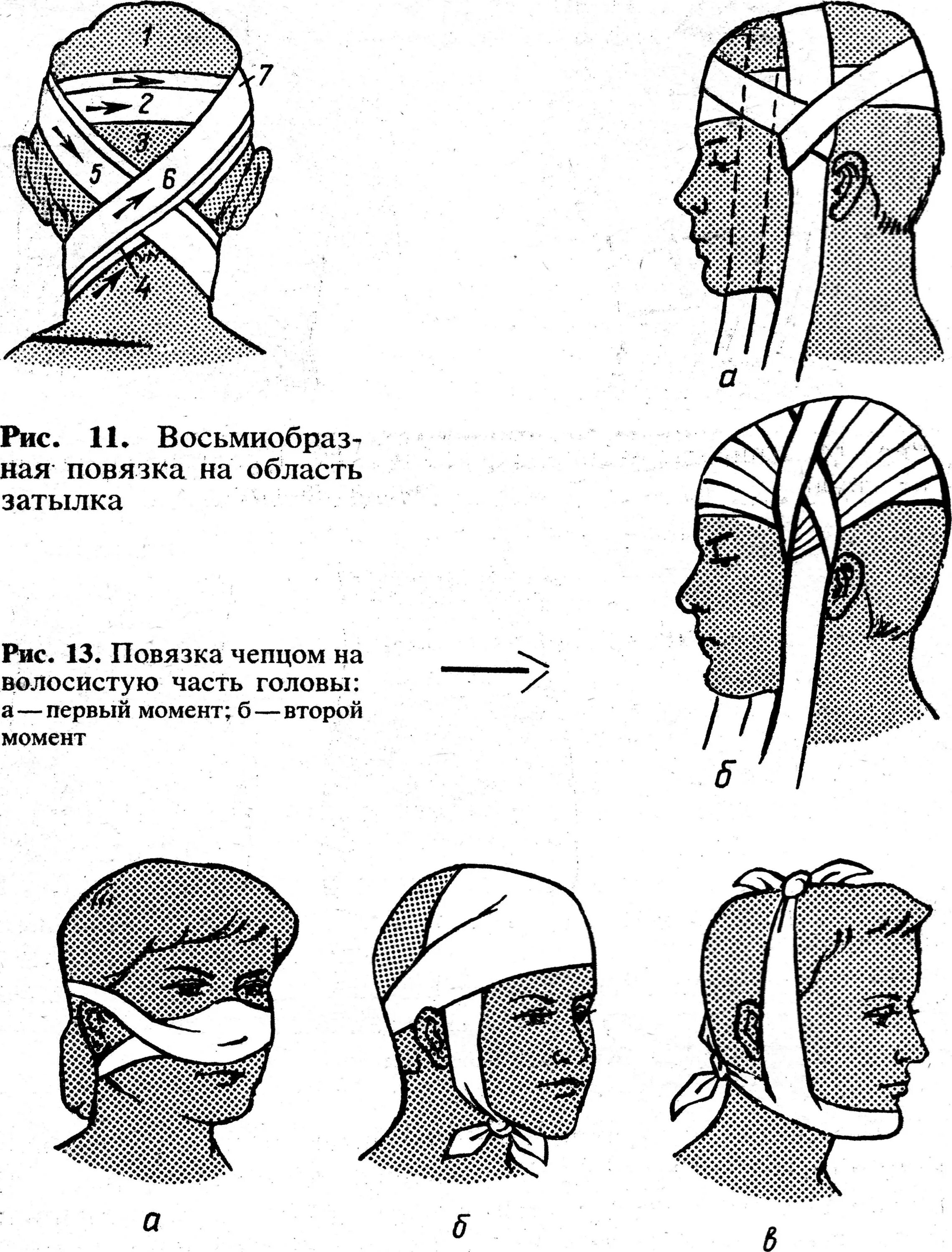 Как перевязывать голову. Пращевидная повязка техника. Повязка чепец техника. Пращевидная повязка на затылок. Пращевидная повязка показания.