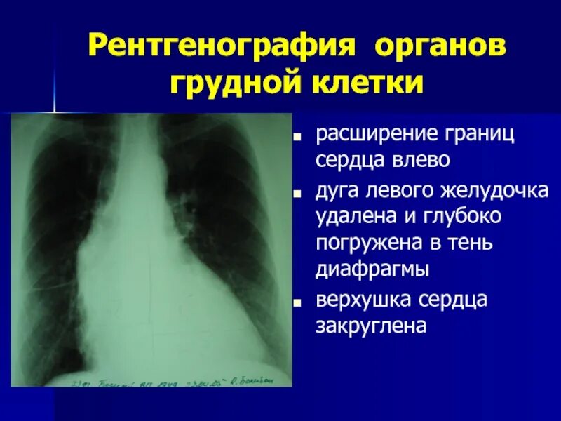 Что значит сердце увеличено влево. Расширение тени сердца на рентгенограмме. рентгенография грудной клетки расширение границ сердца. на рентгене расширены границы сердца. расширение тени сердца влево на рентгенограмме.