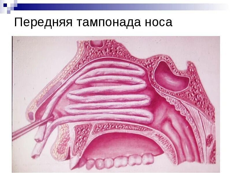 Передняя тампонада при носовом кровотечении. Передняя тампонада полости носа. Задняя тампонада полости носа алгоритм. Задняя тампонада полости носа техника. Передняя и задняя тампонада полости носа.