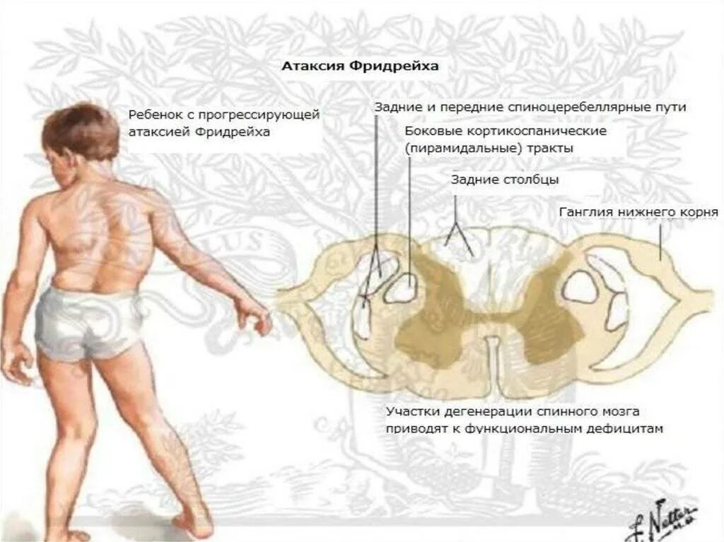 Клинические проявления атаксии фридрейха. Синдром уиллиамсона спинной мозг. Атаксия мозга. Виды атаксий. Статическая мозжечковая атаксия.