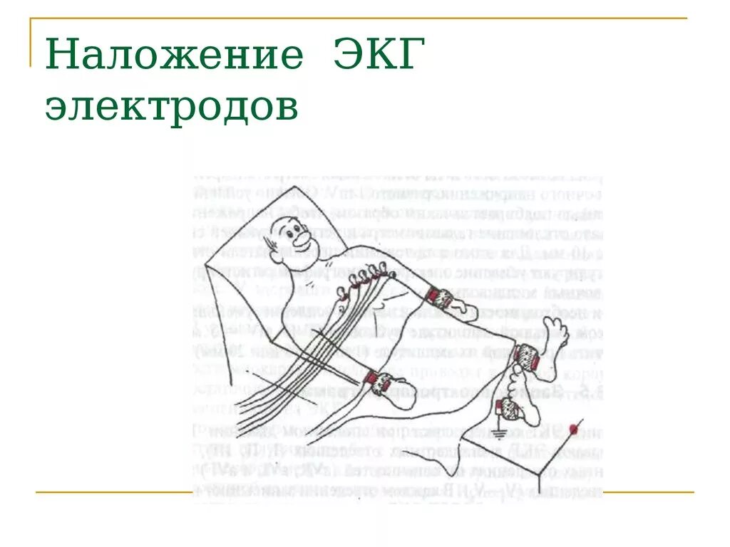 Электроды ЭКГ схема наложения. Алгоритм наложения электродов для снятия ЭКГ. Методика снятия ЭКГ наложение электродов. Методика наложения электродов при ЭКГ. Соп экг