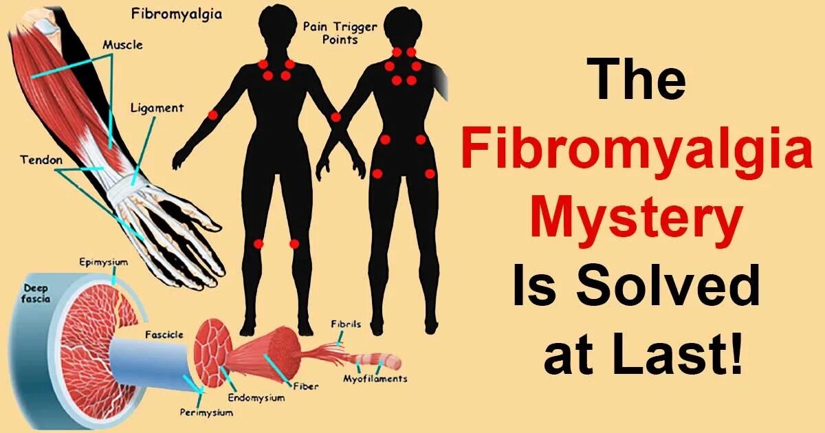 Фибромиалгия. Фибро алгия. Фибромиалгия / Fibromyalgia. Фибромиалгия симптомы причины и лечение