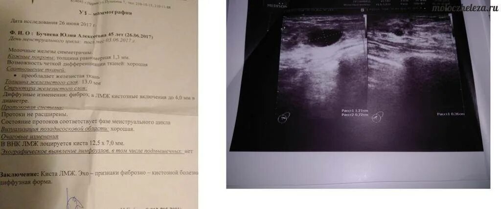 Импланты молочных желез УЗИ заключение. Импланты на УЗИ протокол. Фиброаденома молочной железы УЗИ протокол. Протоки молочной железы на УЗИ.